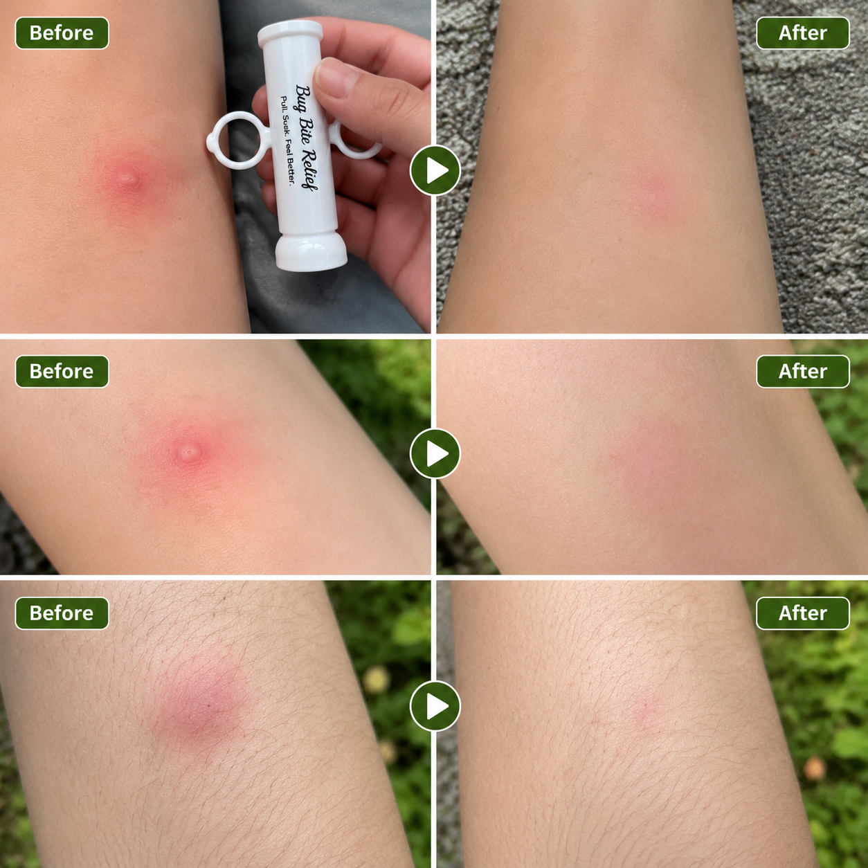 Stop Mosquito Bite Itch In Seconds-Reusable, Portable & Chemical-Free